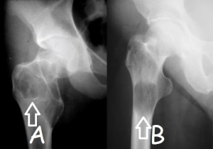 Rentgenski posnetek benignega (A) in malignega (B) tumorja z bolečino v kolku
