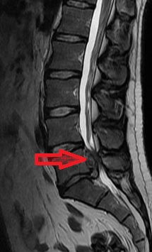 Hernija medvretenčne ploščice s kritično utesnitvijo hrbteničnega kanala