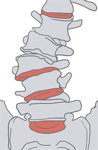 Shematski prikaz degenerativne skolioze ledvene hrbtenice