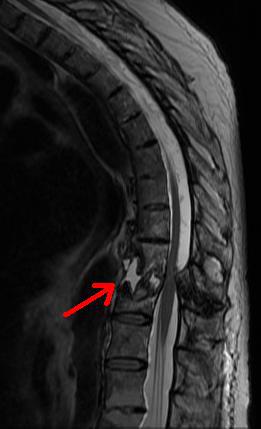 MR posnetek Anderssonove lezije po stresnem zlomu hrbtenice pri ankilozantnem spondilitisu