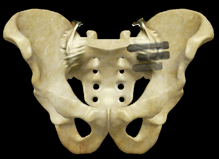 Shematski prikaz titanijevih implantatov v sakro-iliakalnem sklepu