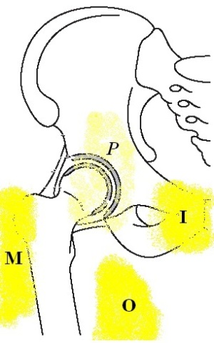 Lokalizacija bolečine ob kolku pri utesnitvi ilioingvinalnega živca (I), obturatornega živca (O), meralgiji paresthetici (M) in sindromu piriformisa (P)