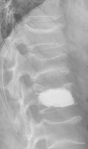 RTG hrbtenice po opravljenem cementiranju (vertebroplastiki) zlomljenega vretenca