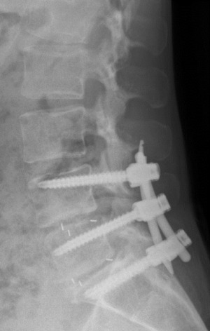 Uporaba vijakov, palic in medvretenčnih kletk pri minimalno invazivni zatrditvi dveh segmentov ledvene hrbtenice