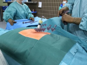 Cementiranje osteoporotičnih zlomov 