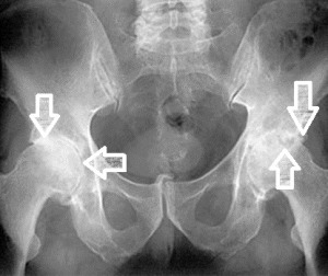 Značilna rentgenska slika napredovale artroze kolka z zoženo sklepno špranjo, osteofiti, degenerativnimi cistami in sklerozo