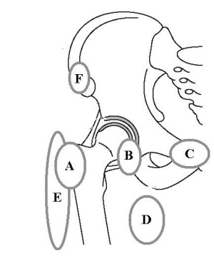 Pogosta mesta nesklepne bolečine v okolici kolka (A – trohanterni burzitis / preskakujoči kolk, B - iliopsoasni burzitis, C – utesnitev ilioingvinalnega živca, D – utesnitev obturatornega živca, E – meralgia paresthetica, F – avulzija iliakalne apofize).