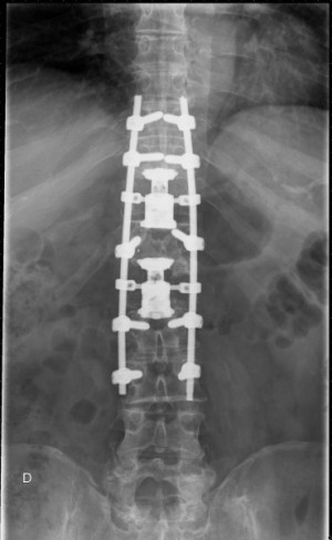 RTG hrbtenice po odstranitvi dveh vretenc zaradi zasevka neznanega izvora