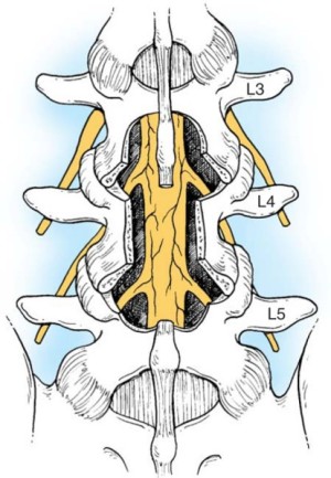 Sproščanje živčnih korenin z operativno dekompresijo ledvene hrbtenice